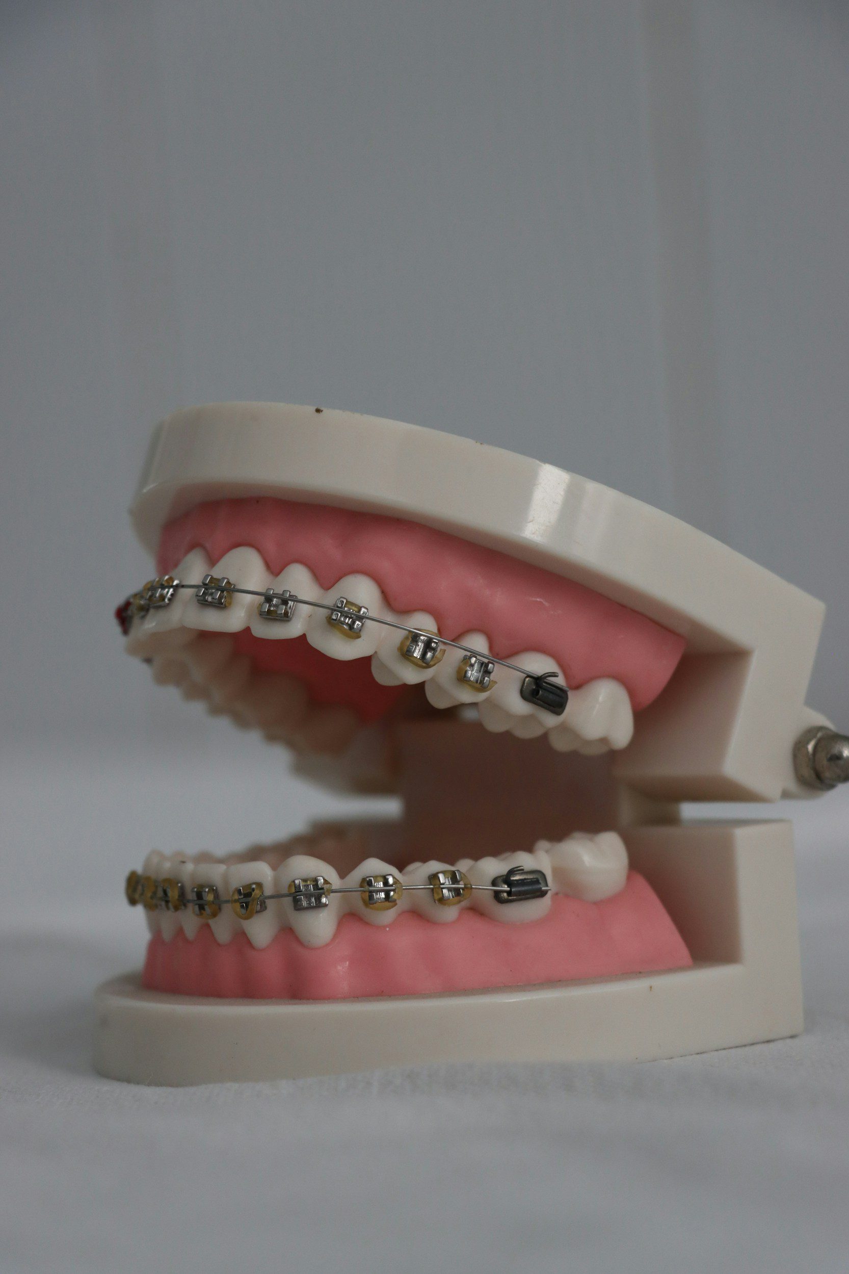 Modèle de mâchoire avec appareil orthodontique à bagues