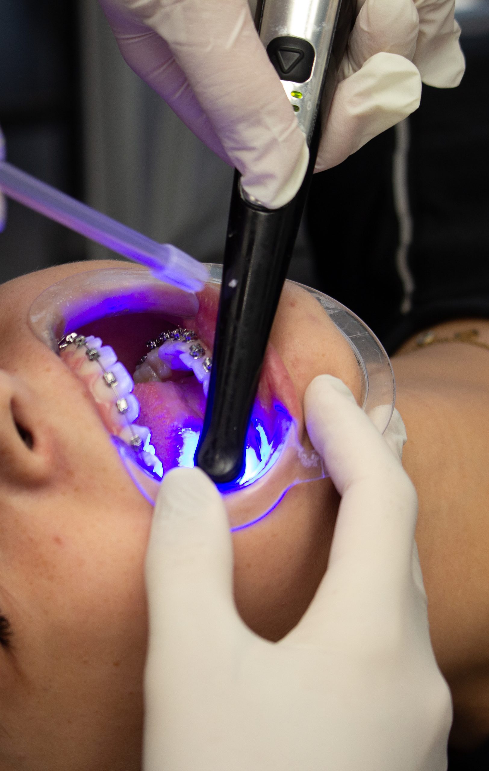 Utilisation d'une lampe à photopolymérisation bleue pour fixer les bagues d'un appareil orthodontique.