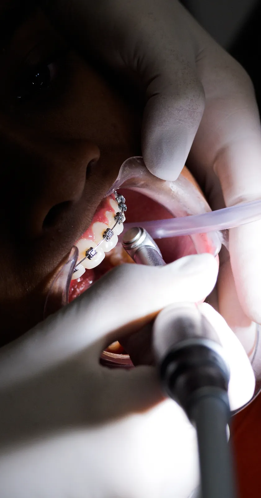 Réglage d’un appareil orthodontique à bagues