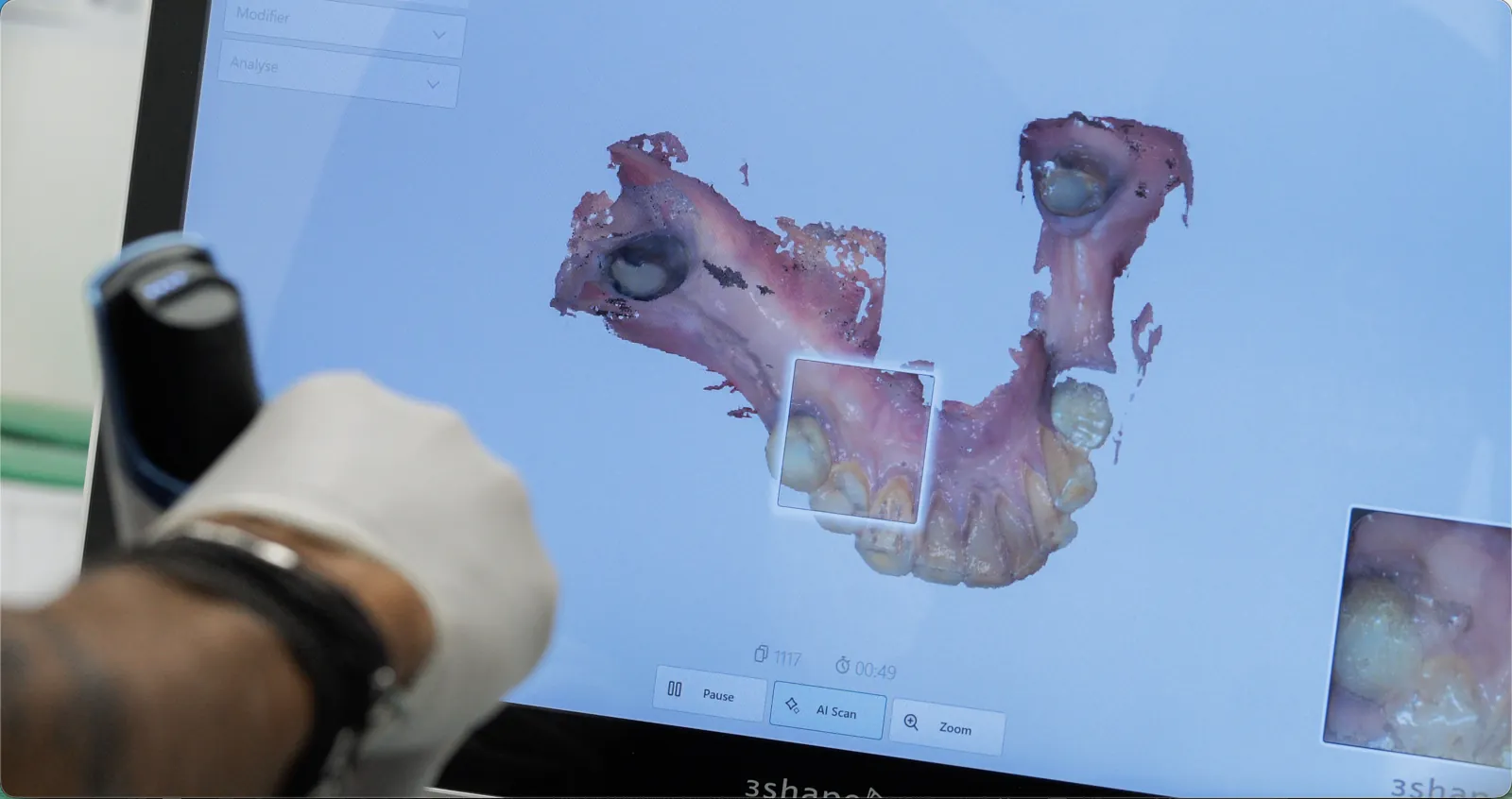 Planification d’un implant dentaire sur modèle 3D