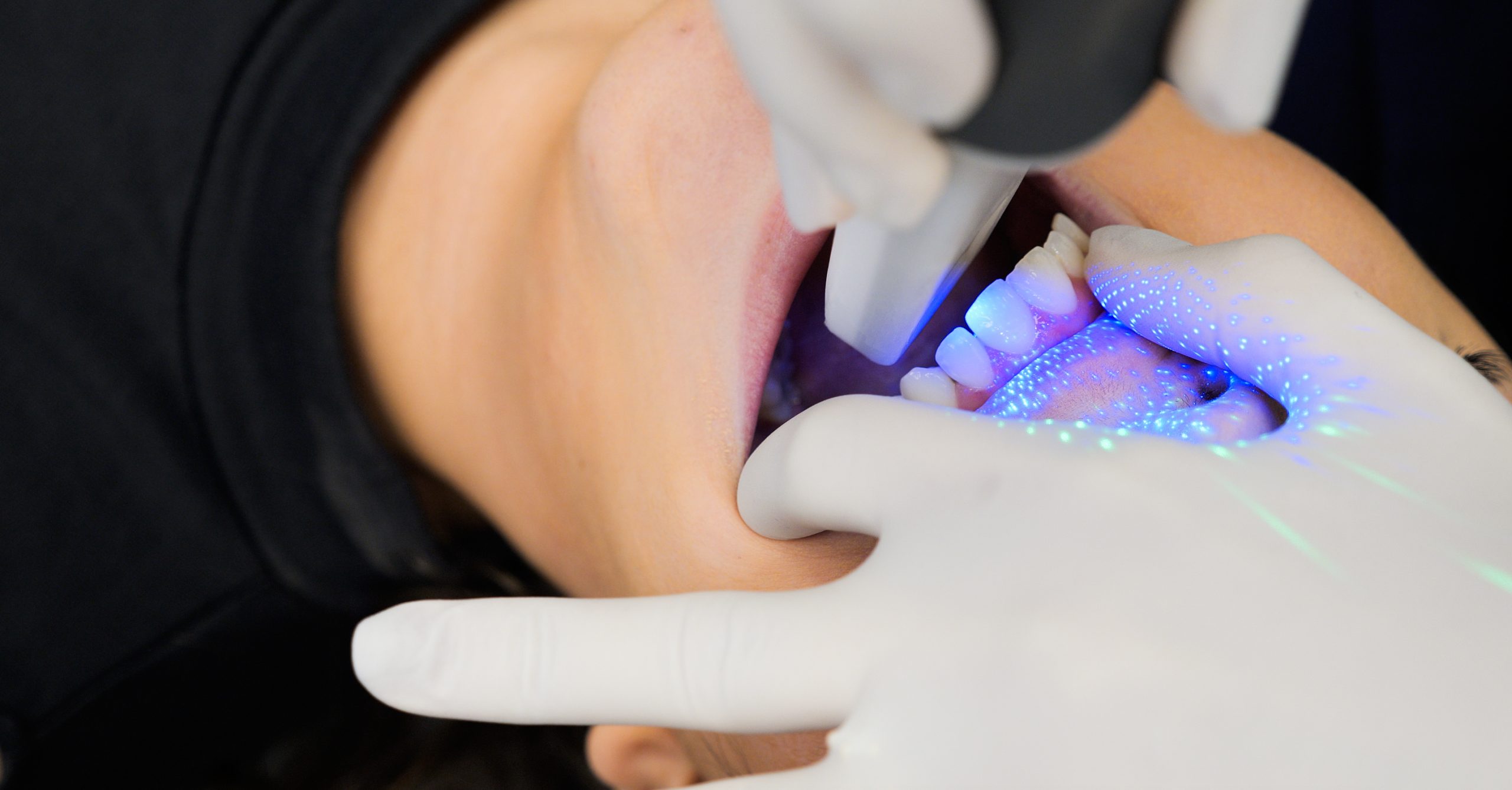 Prise d'empreinte numérique 3D des dents d'un patient à l'aide d'une caméra intra-orale lumineuse.